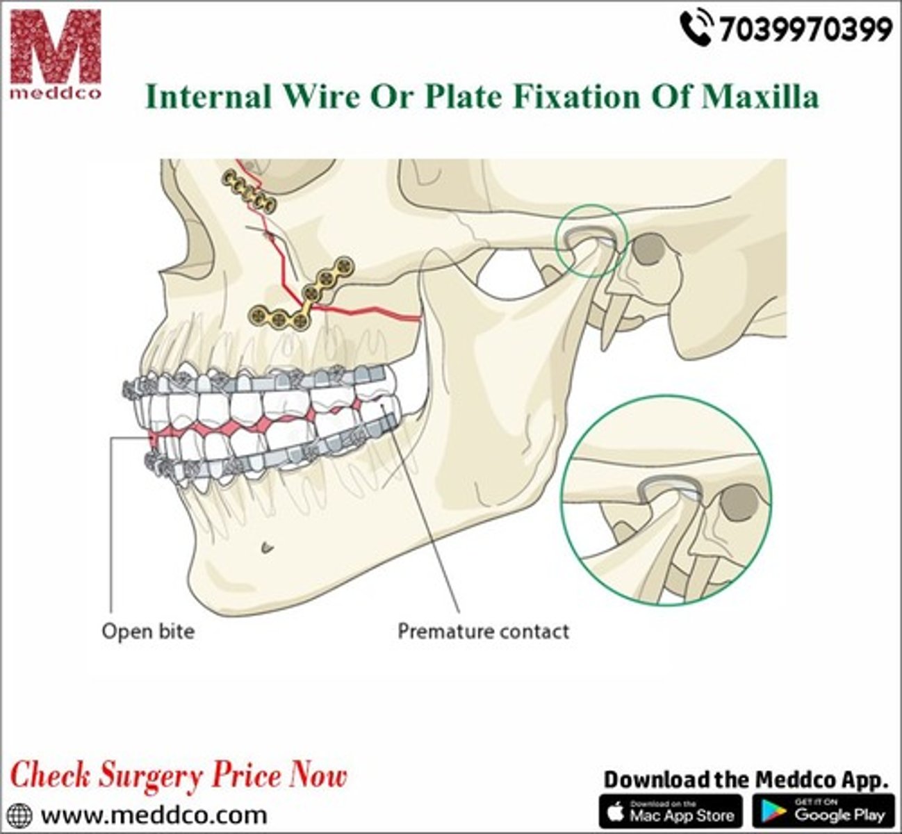 <p>indications: </p><p>Fragments are significantly displaced</p><p>Fracture passes through pathological bone</p><p>Strong stabilization is needed</p><p>advantages: </p><p>Rigid fixation</p><p>Better healing</p><p>Better stability</p>