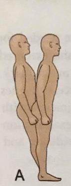 <ul><li><p>Anteroposterior perturbations</p></li><li><p>Ankle movement to restore COM</p><ul><li><p>Forward loss of balance: gastrocs → hammys → paraspinals</p></li><li><p>Backward loss of balance: tib ant → quads → abdominals </p></li></ul></li><li><p>Head movement occurs in-phase with hips </p></li></ul><p></p>