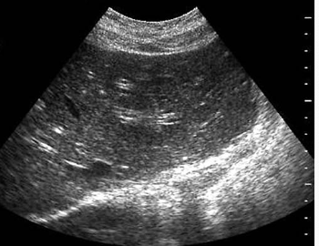 <p><span>A 40-year-old patient arrives for an abdominal ultrasound to rule out gallstones. The patient complains of fatigue, fever, chills, and a loss of appetite for the previous week. Laboratory tests show marked elevation in AST, ALT, and bilirubin levels. Based on this clinical history, the sonogram is most suspicious for which of the following pathologies?</span></p>