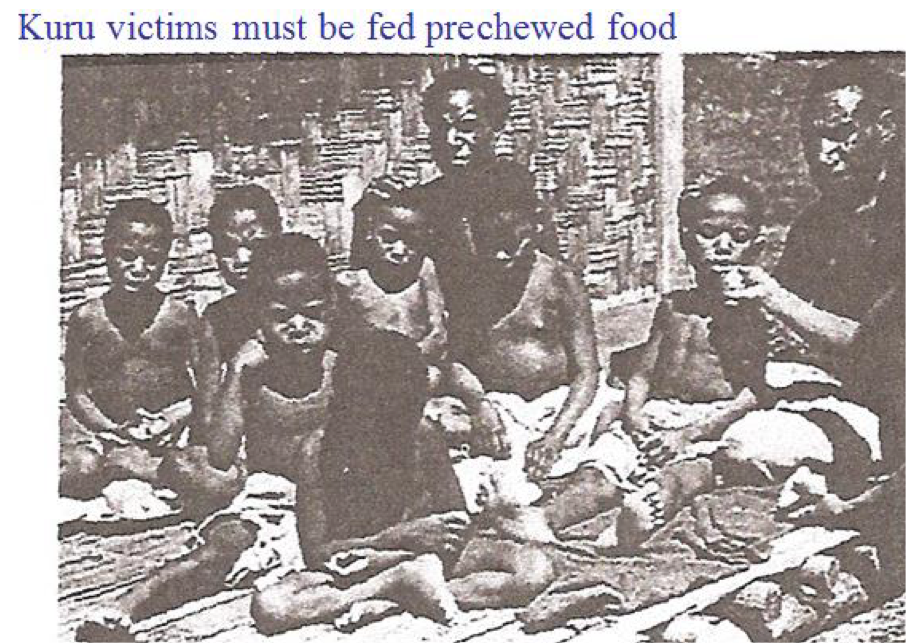 <ul><li><p>Recognized in <strong>cannabalistic</strong> tribes in New Guinea </p></li><li><p><strong>Progressive, Fatal neurological disease </strong></p></li><li><p>Affects the CNS = mental derangement and loss of motor function </p></li><li><p>If tribe member died the women prepared body for burial: women would eat the brain, and children ate the feet </p></li></ul><p></p>