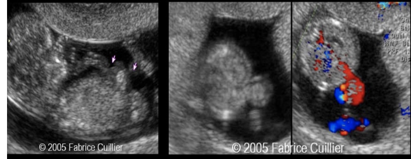 <p>herniation of the midgut is an abn finding in gestations over ___ weeks in age </p><p>a) 8 </p><p>b) 10</p><p>c) 12</p><p>d) 14</p>