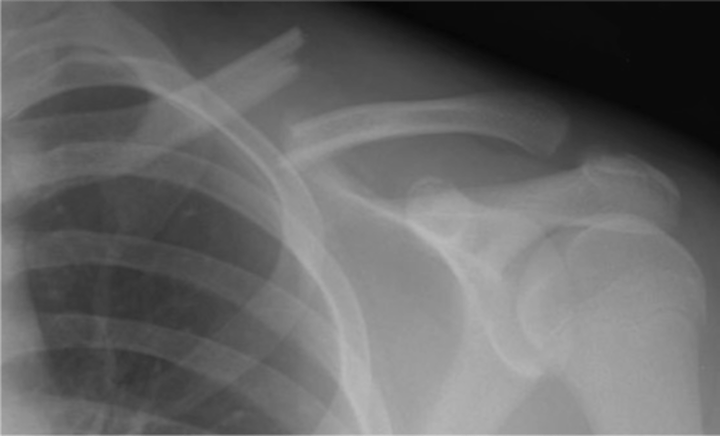 <p>Clavicle</p>