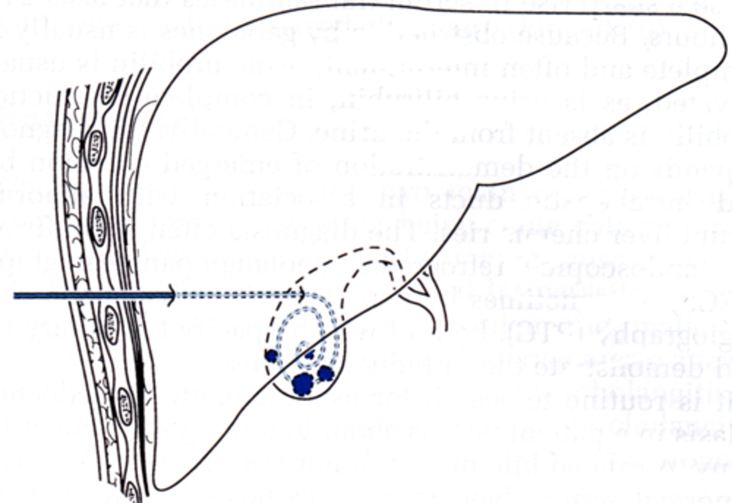 <p>needle is threaded percutaneously into the gallbladder and used to decompress the organ, thus releasing pressure and relieving symptoms, gravity drainage</p><p>Placed by Interventional Radiology</p>