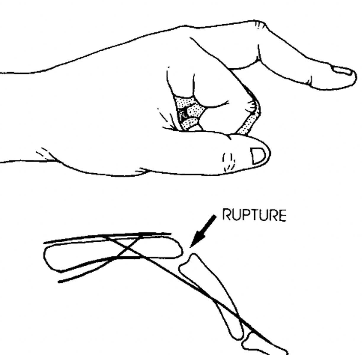 <p>extension of MCP and DIP joint</p><p>flexion of PIP joint</p><p>rupture of central tendinous slip of the extensor hood and is more common after trauma or in RA</p>