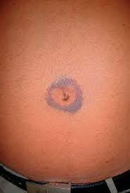 * Irregular, bluish hemorrhagic patches on the skin around the umbilicus and sometimes around abdominal scars 
* Indicate massive hemorrhage