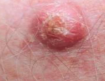 <p>COMMON DISORDERS SEEN WITH AGING</p><p>• Appears as a <span style="color: red;">scaly spot that is crusty</span> </p><p>• Not as serious as melanoma, but <mark data-color="red" style="background-color: red; color: inherit;">can spread quickly if left untreated</mark></p>