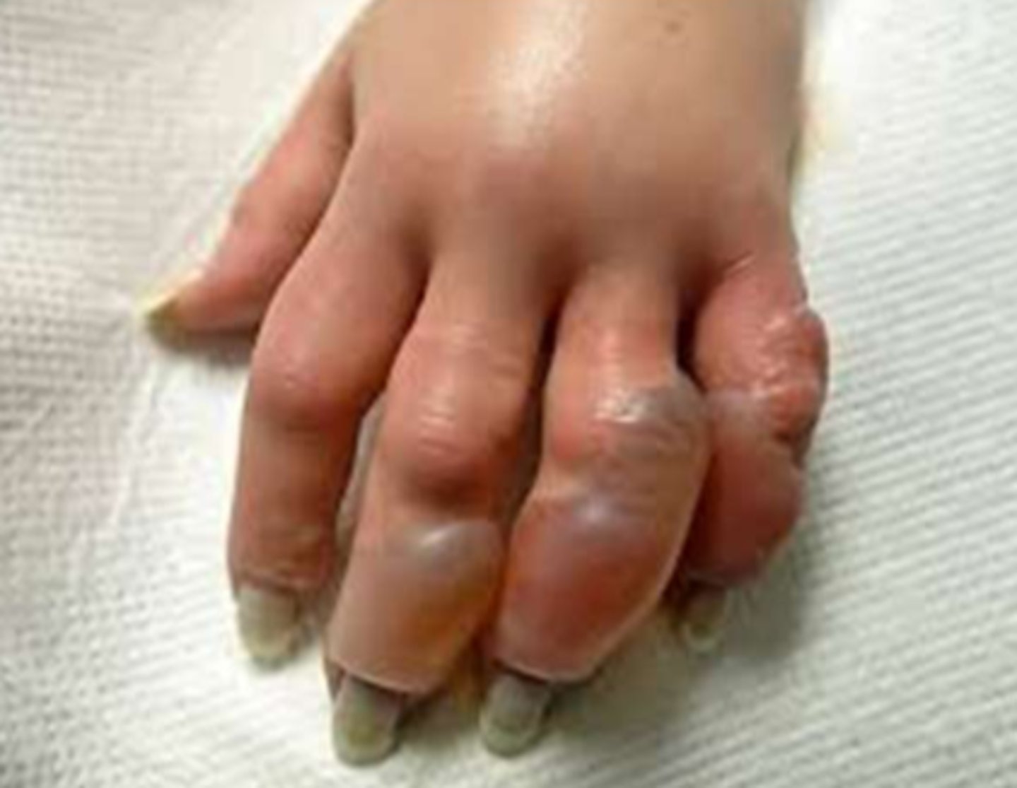 <p>- frostbite: the freezing of body tissues due to prolonged exposure to cold temperatures, leading to cellular injury</p><p>- when we suspect it: pts with exposure to ≤0℃ for several mins/hours with inadequate protection to extremities</p><p>- physical exam will present pain/tingling/loss of sensation in digits or extremities</p>