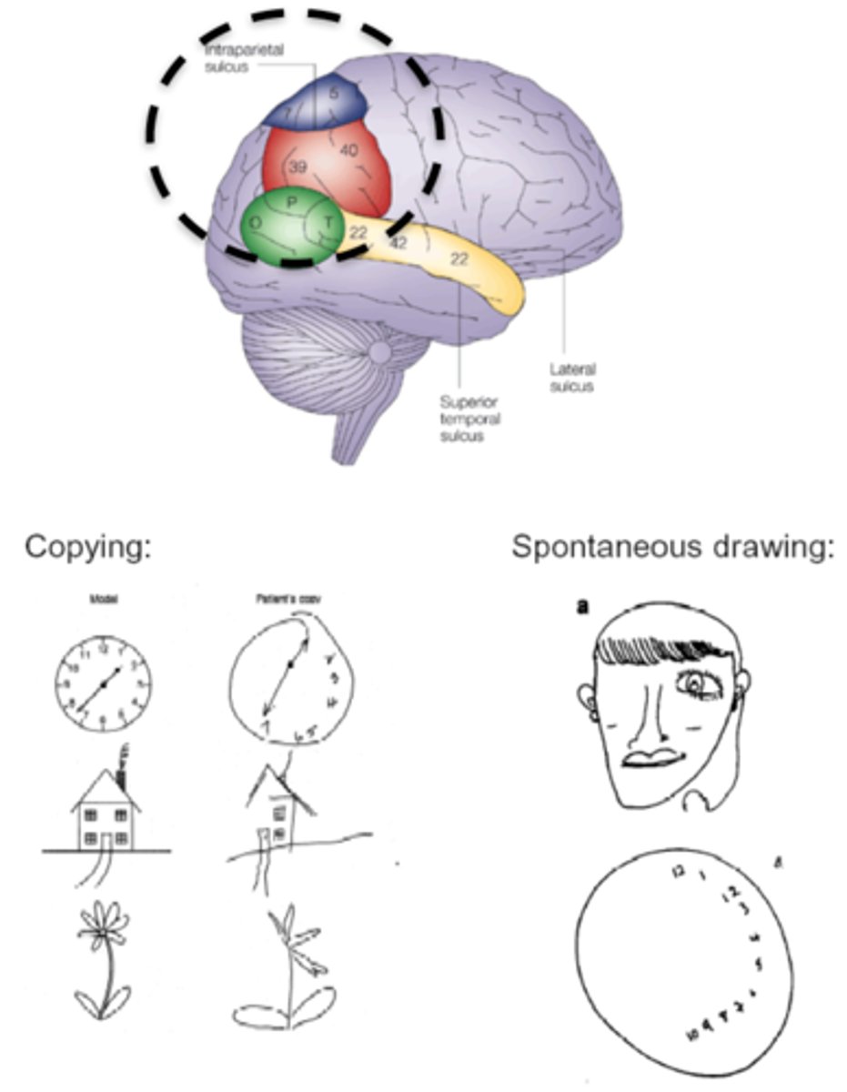 <p>patients are UNAWARE of one half of the world; they are NOT BLIND they just do not direct any attention to that space<br>- lack of visual attention<br>- includes anosognosia (they don't think anything's wrong with them; ex: im full theres no more food on my plate; when in reality there is a whole half plate of food left)</p>