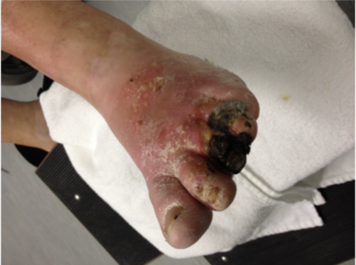 <p>WOUND BED ASSESSMENT</p><p>gangrene--> dead/decaying tissue</p><p>*usually greenish-black color</p><p>**can be dry or wet</p>