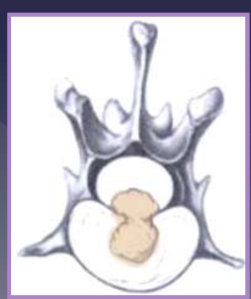 <p>intervertebral disk herniation </p>