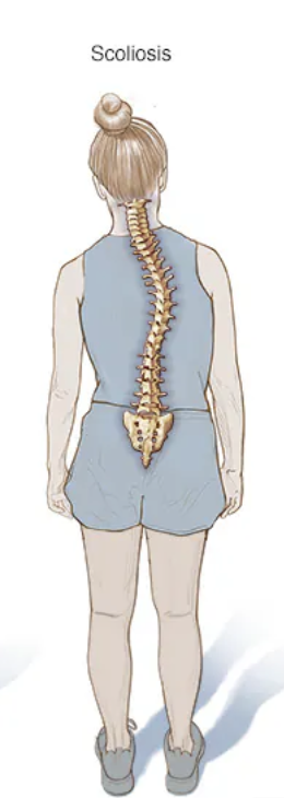 <p>What is <mark data-color="yellow"><u><strong>scoliosis</strong></u></mark><strong>?</strong></p>