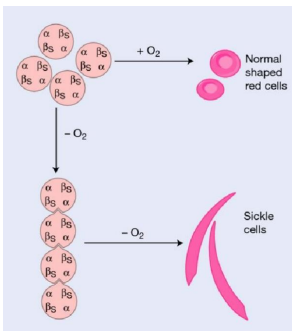 <ul><li><p>in low oxygen conditions, Hb polymerises</p></li><li><p>long fibres form crystals</p></li><li><p>causes rigid “sickle” RBCs</p></li></ul><p>causes obstruction of RBC circulation and anaemia from extravascular haemolysis</p>