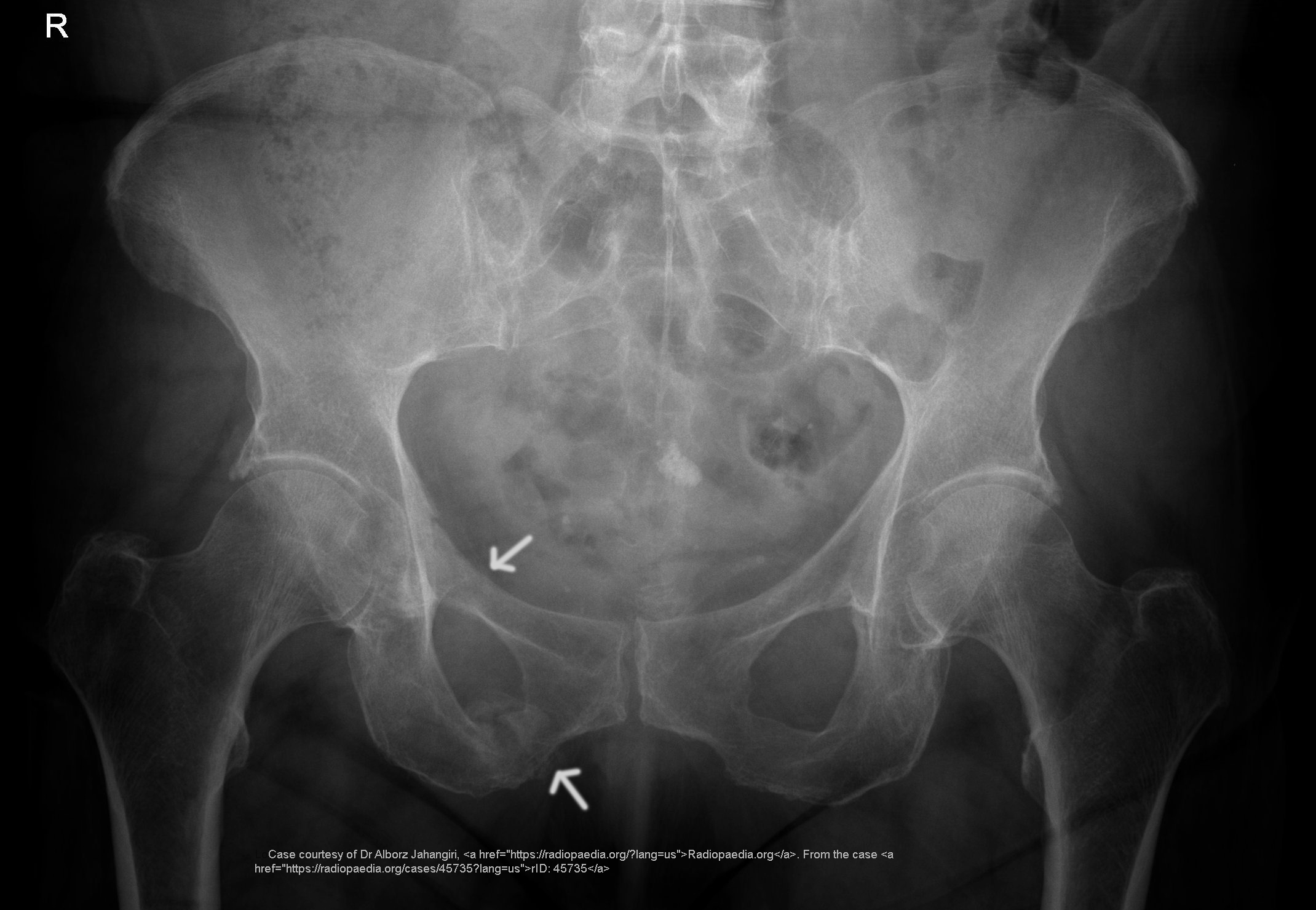 <ul><li><p><span>a fractured pelvis that can withstand normal forces without deformation; involve a single break along the peripheral margins</span></p></li><li><p><span>MOI = moderate trauma to the pelvis</span></p></li><li><p><span>Reduction of the fracture and surgical intervention, with a screw or plate</span></p></li><li><p>Neurological problems leading to bladder problems, post-surgical bowel obstruction</p></li></ul><p></p>