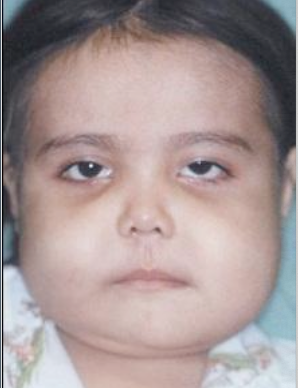 <ul><li><p>Clinical alterations progress until puberty, then stabilize and slowly regress, asymptomatic</p></li><li><p>There is an “eyes upturned to heaven” appearance due to a wide rim of exposed sclera noted below the iris</p></li></ul><p></p>