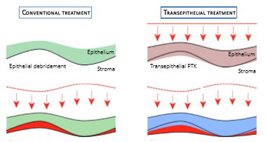 <p>Irregulær astigmatisme (ujævnt epitel) - keratoconus </p><p>Utilstrækkelige langtidsstudier </p>