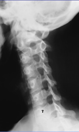 <p>What is this x-ray demonstrating?</p>