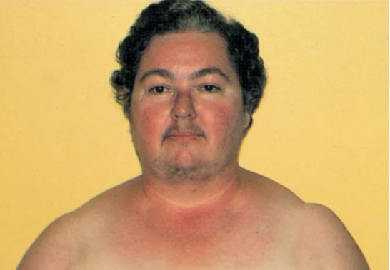 <p>what are clinical manifestations of Cushing syndrome?</p>