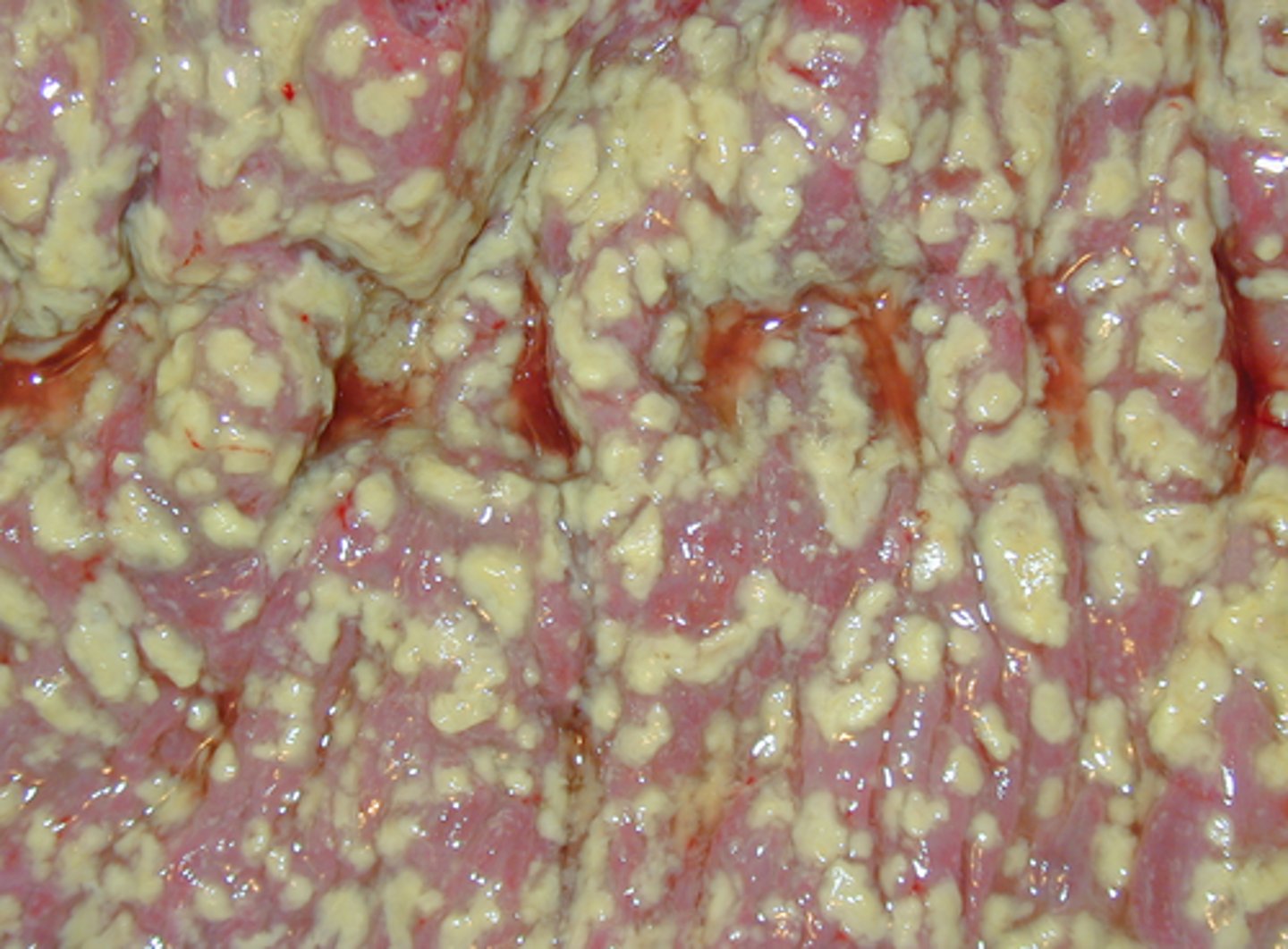 <p>Pathogen: Clostridium difficile</p><p>S+S: Inflammation of the colon --&gt; bloody diarrhea 1-2 weeks after starting oral antibiotic therapy</p><p>Transmission: Fecal-oral route (spores persist on surfaces for weeks)</p>