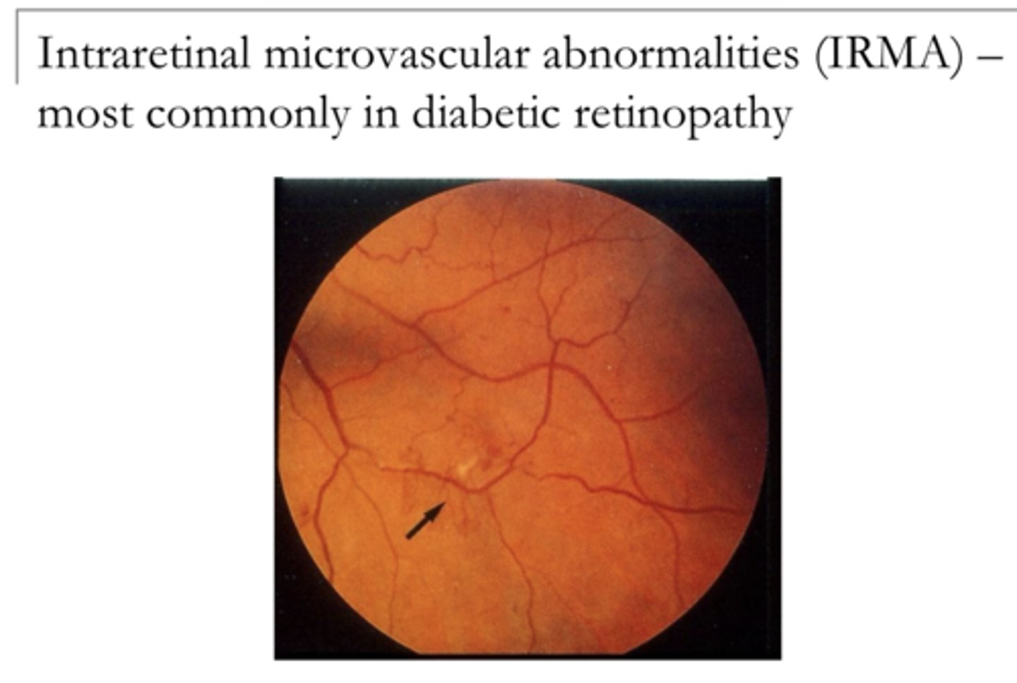 <p>Intraretinal Microvascular Abnormalities (IRMA) (Pic)</p>