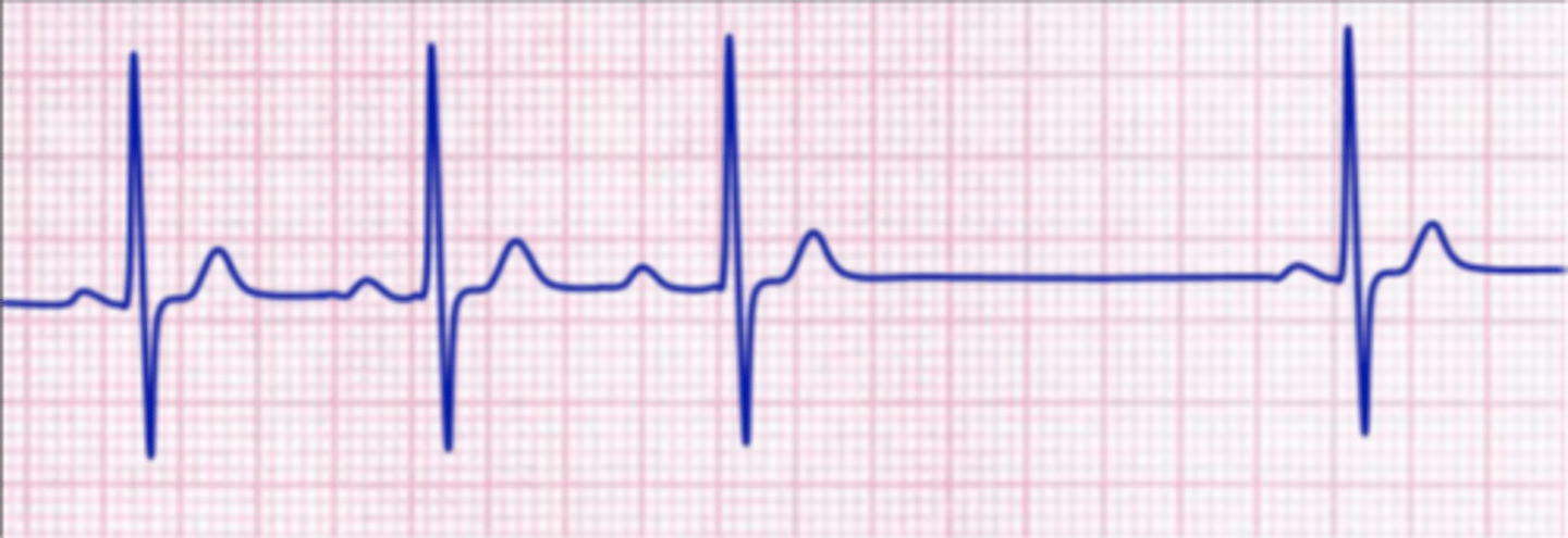 <p>repeating pattern where all but one of a series of atrial impulses are conducted through AV node;</p><p>each impulse takes a longer time for conduction than the one before, until one is blocked</p>