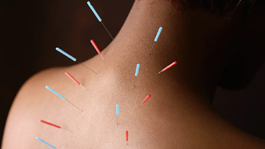 <p>A form of energy medicine where long thin needles are inserted to specific parts of the body to affect the energy flow</p>