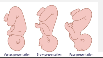 <p><strong>Brow, Chin, Face Presentations</strong></p><p>-Face → ____________ of the fetal head, so clinician is unable to feel sutures on vaginal exam&nbsp;</p><p>-Brow → caused by partial ________ of the fetal head</p><p>-Mentum (____) → prolonged labor is common</p>
