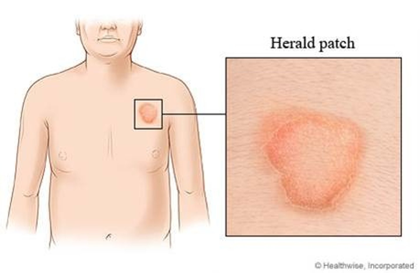 <p>HERALD PATCH (bigger than other</p><p>lesions)</p>