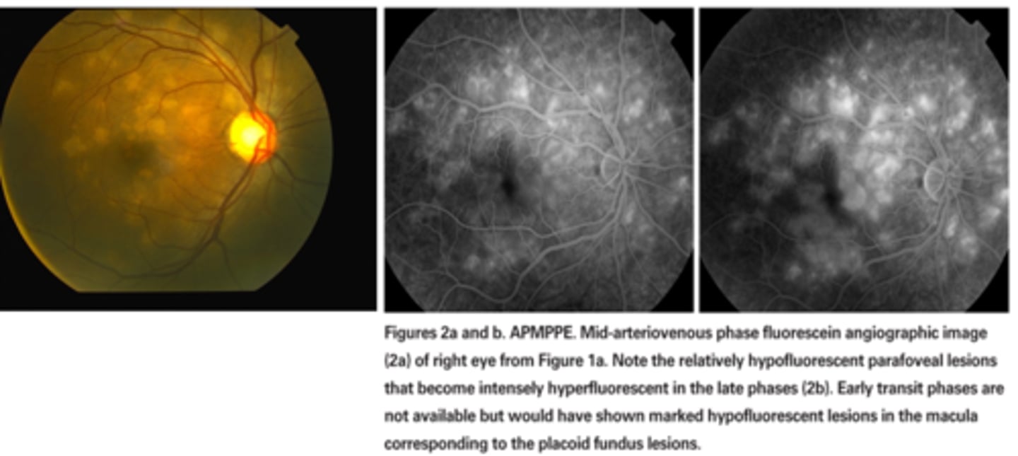 <p>ex) plaquoid pigment epitheliopathy = hyperF RPE lesions get brighter over the course of the IVFA = ischemic chorioretinal inflam spots will "stain"</p>