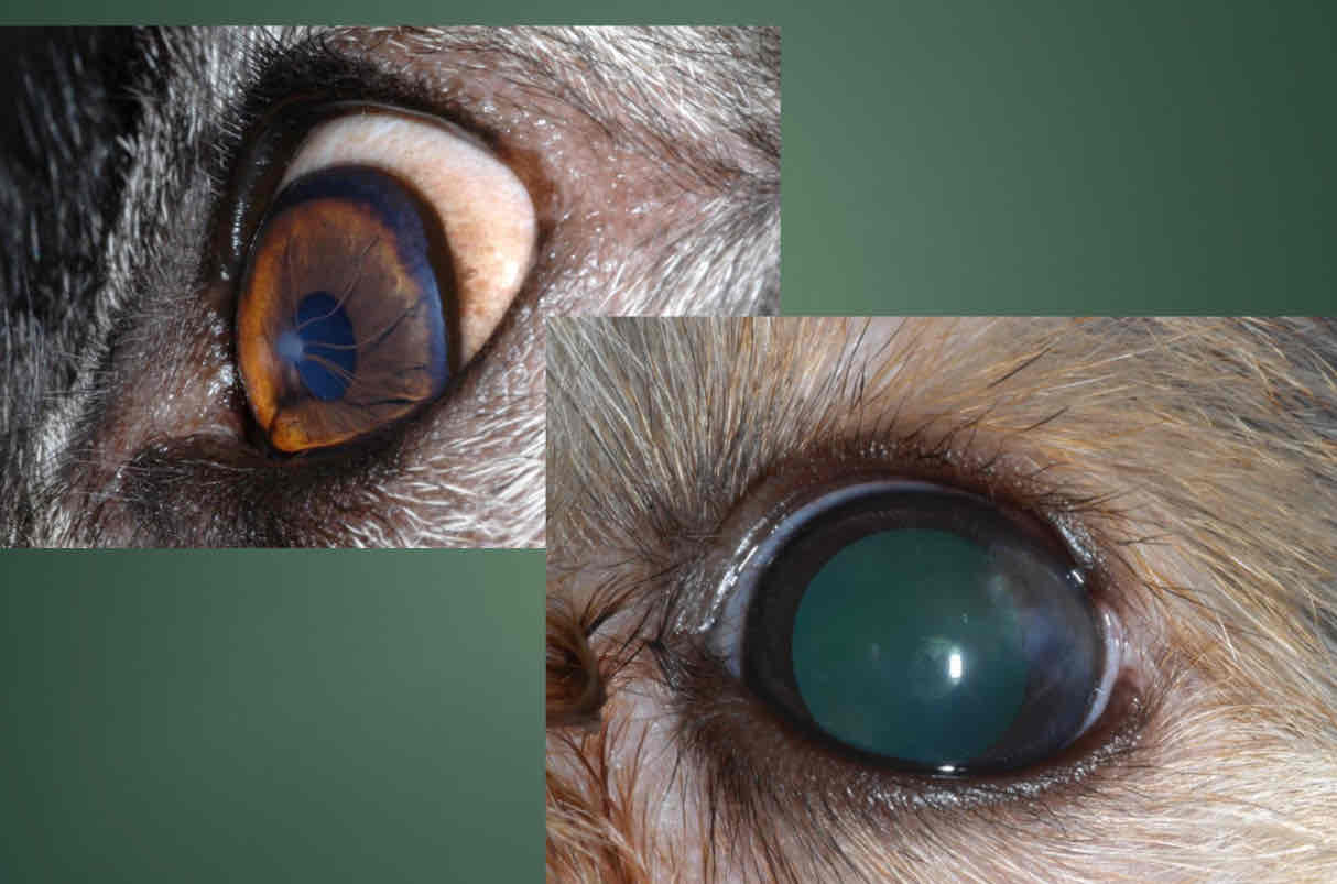 <p>Disorganized collagen. Associated with previous keratitis. Maybe associated with vascularization and pigmentation. Nonpainful. Does not need treatment. </p>