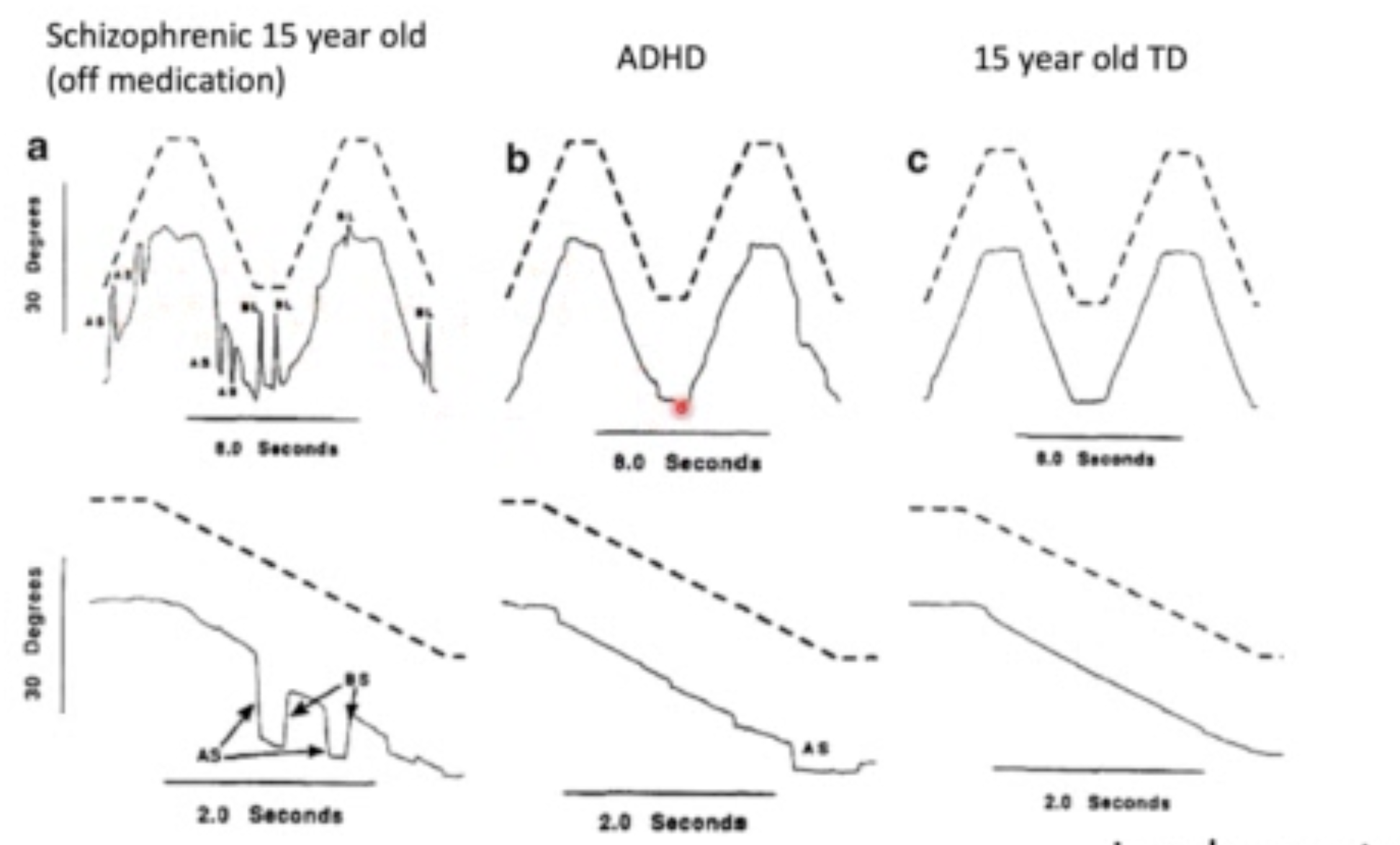 <p>Context: There are fronto-striatal deficits that make it difficult for these individuals to inhibit reflexive responses, leading to hypotheses that people with ADHD may have some more crazy eye movements going on - not really the case!</p><p></p><p>The Jacobsen et al. (1996) study showed that whilst there are differences between ADHD and HC, the differences are not as significant as schizophrenics.</p><ul><li><p>Can do smooth pursuits fine (image)</p></li><li><p>Struggles with saccadic inhibition (Munoz et al., 2003)</p></li></ul><p></p><p>Think: They just can’t stop themselves from looking!</p>