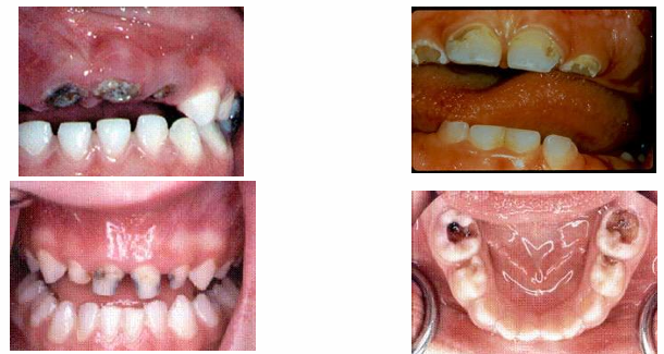 <p>-decay that extends all the way to the gingiva anteriorly or very extensively occlusally in the posterior</p>