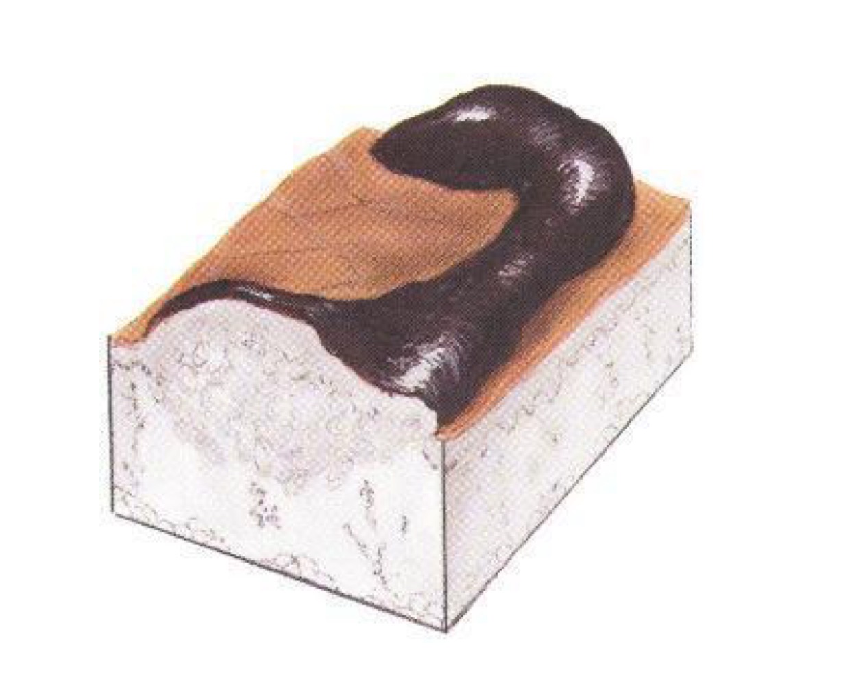 <p>what type of skin lesion is this? </p>