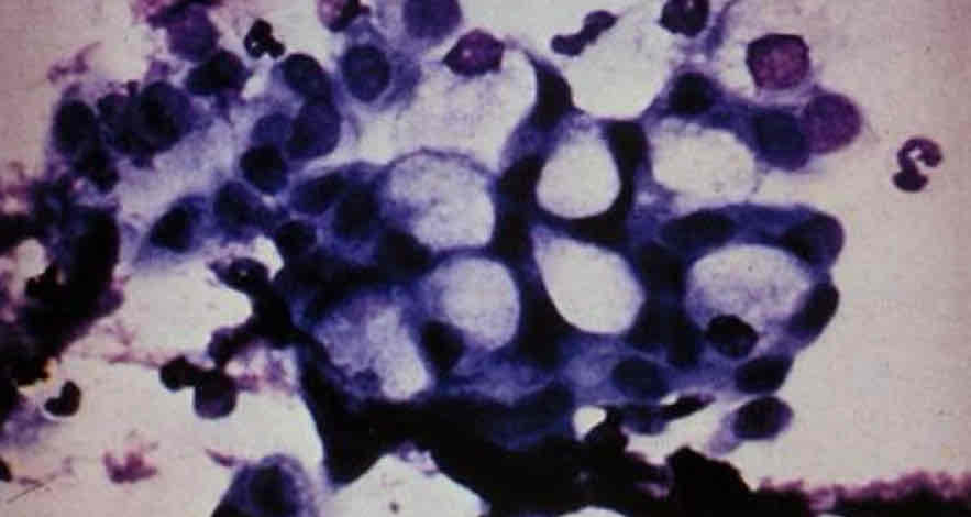 <p>may be recognized by the large amount of mucin which displaces the nucleus to the periphery. Areas of mucus may stain light blue or appear as clear areas. Giemsa stain.</p>