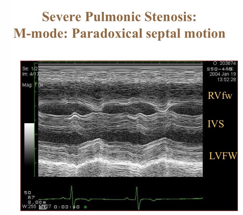 <p>When are the walls moving together (parallel movment(</p>