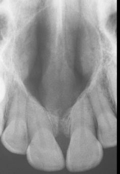 <p>well-defined corticated heart-shaped lesion in the anterior maxilla (may be on midline or slightly off center) </p>