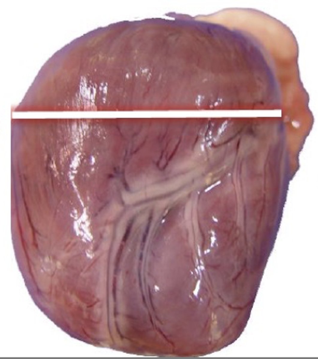 <p>If a patient has a heart that is gross in appearance as shown in the picture, what are some underlying causes? (Multiple answers apply)</p><p>A. Mitral valve disease</p><p>B. DCM</p><p>C. Aortic stenosis</p><p>D. Pulmonary hypertension</p><p>E. HCM</p><p>F. VSD</p><p>G. Pulmonic stenosis</p>