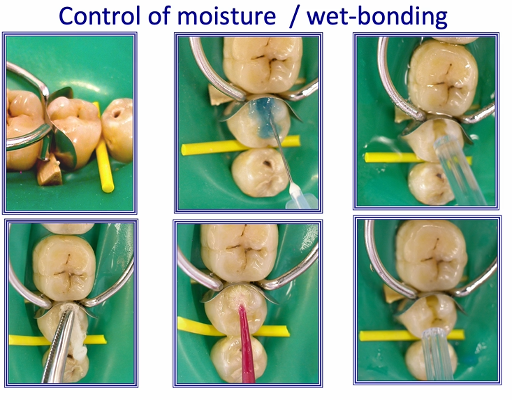 <p>image shows proximal cavity&nbsp;</p><ol><li><p>enamel is etched&nbsp;</p></li><li><p>dentine is etched&nbsp;</p></li><li><p>this is <strong>washed away</strong> with a good stream of water&nbsp;</p></li><li><p>surplus water is removed using a cotton pledget or paper towel or air syringe&nbsp;</p></li><li><p>a large amount of adhesive is placed onto the tooth and rubbed into it gently</p></li><li><p>critical step - evaporate all the solvent that was within the adhesive you just applied - you know you’ve achieved the correct degree of evaporation when there is no  longer any rippling on the surface under the air stream&nbsp;</p></li><li><p>once the surface is shiny but not rippling - light cure the adhesive - it’s ready for the composite to be placed </p></li></ol><p></p>