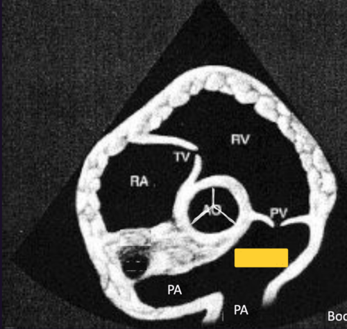 <p>Right Parasternal Short Axis View&nbsp;@ pulmonic valve</p>