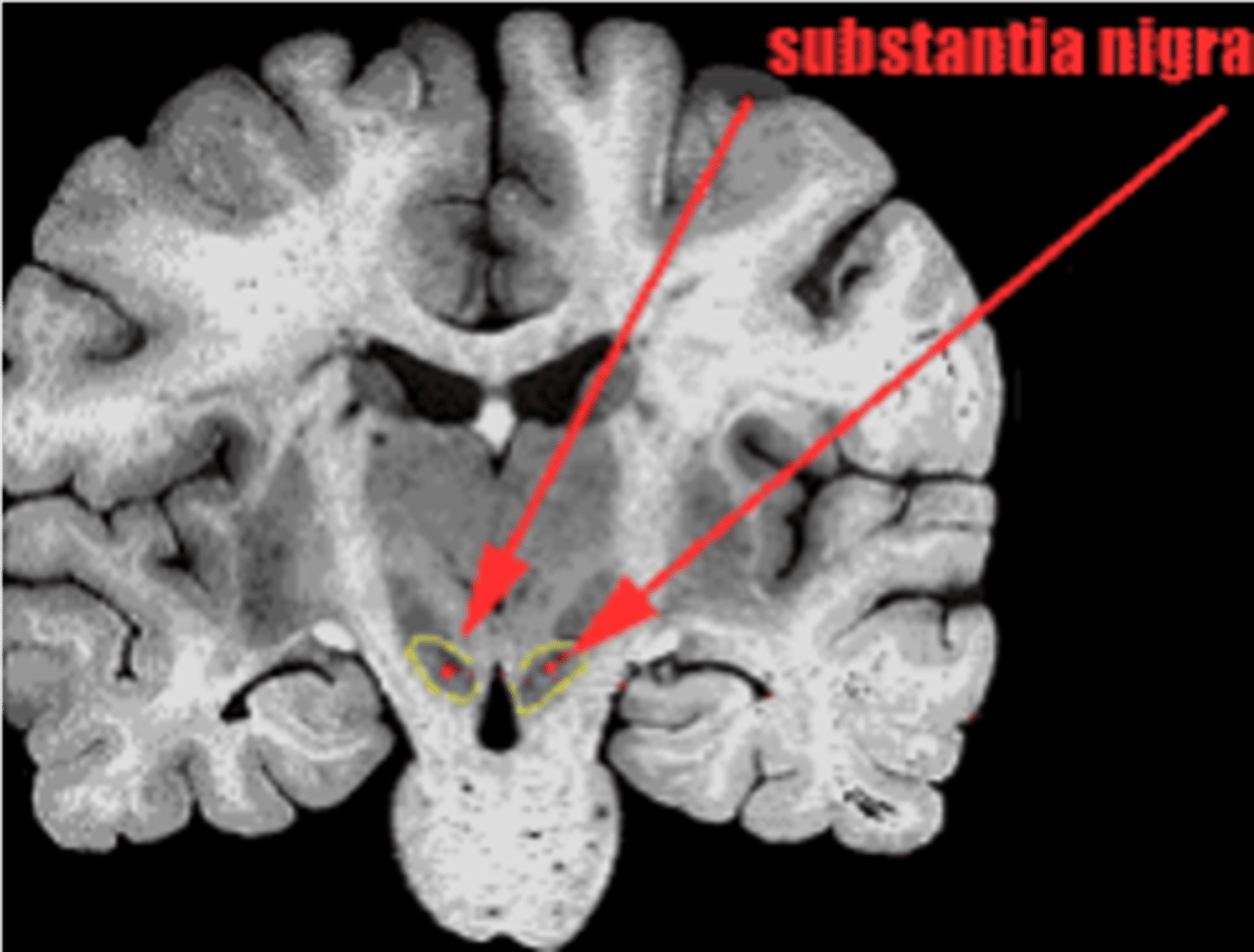 <p>80% of the brain's dopamine is found in the ________ ________, specifically the _____________ ______ (SN)</p>