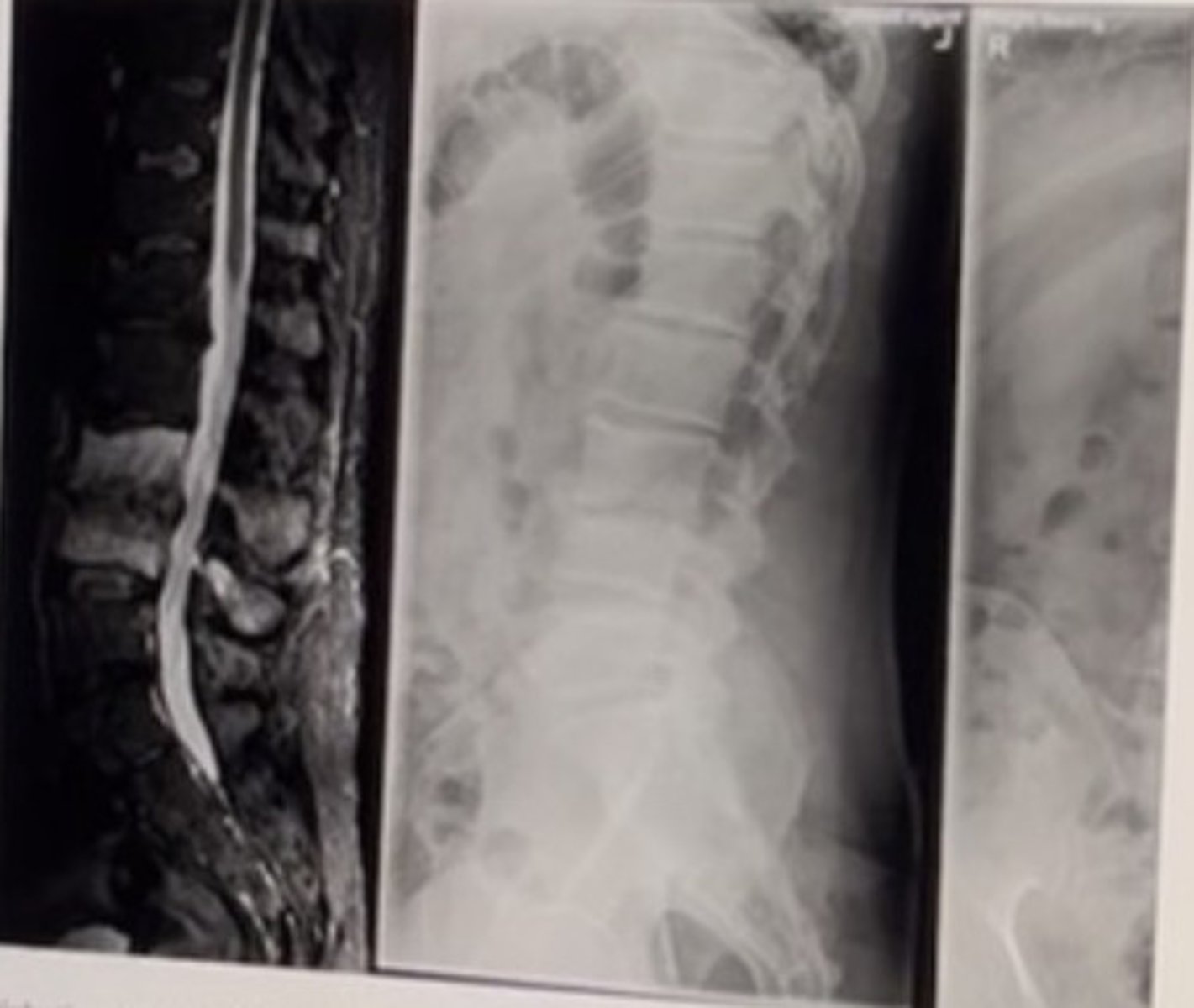 <p>Diabetic patient with low back pain of 3 weeks that is getting progressively worse.</p><p>Best management:</p><p>Urgent referral to emergency department</p><p>No referral necessary; begin chiropractic care</p><p>Refer for bone scan to find other areas of involvement</p><p>Refer to oncologist</p>