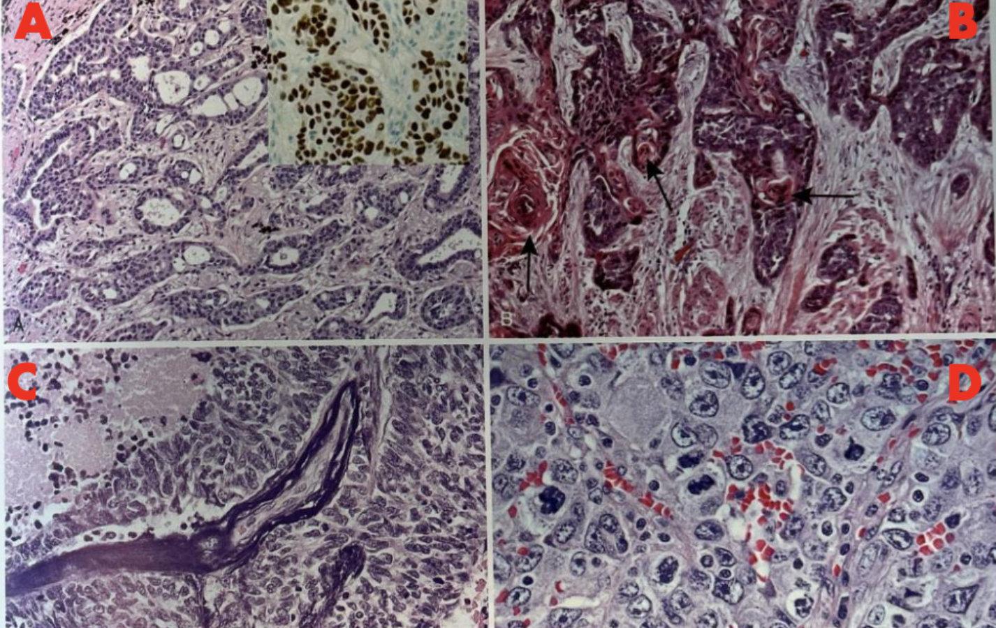 <p>Carcinoma de células gigantes</p>