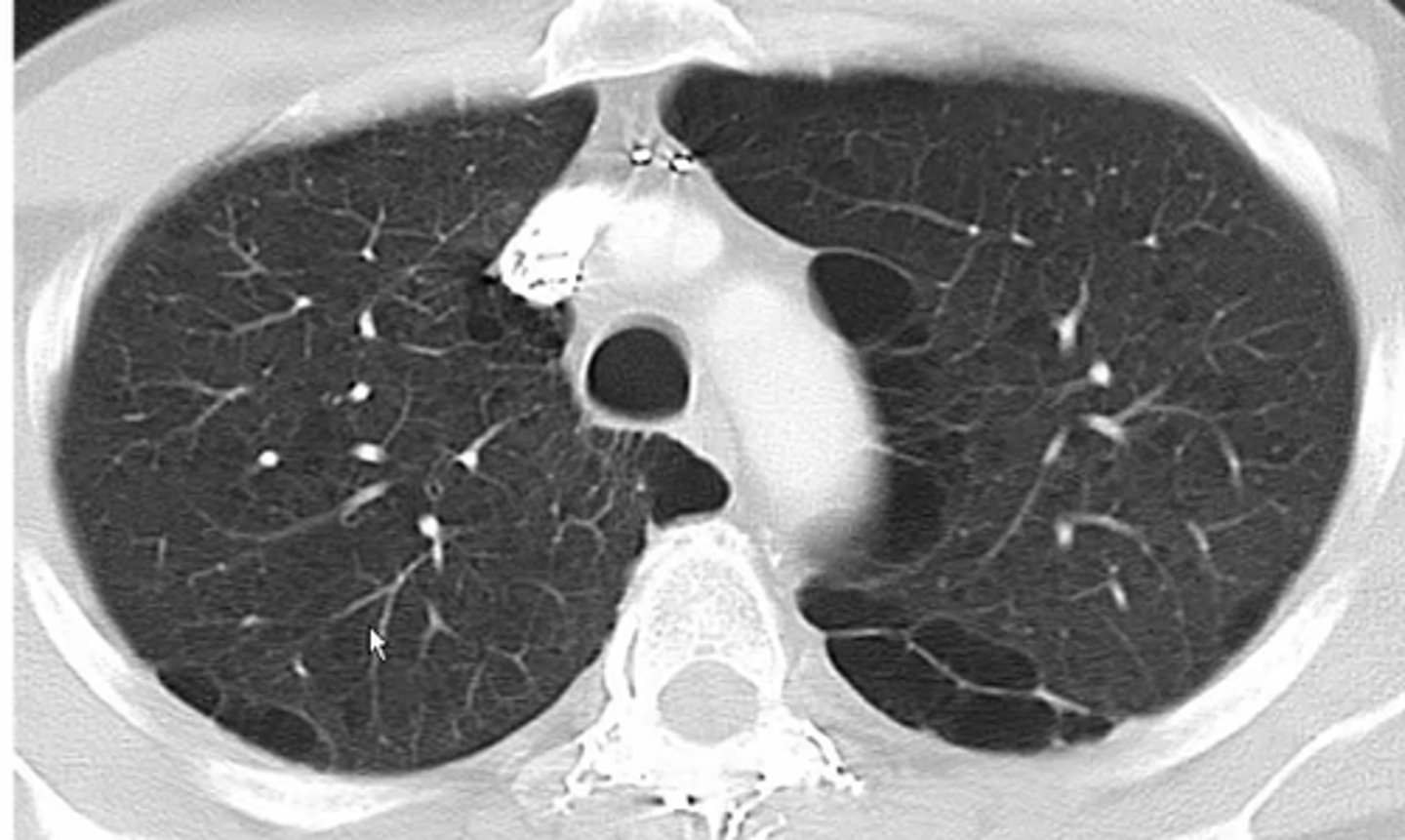<p>Dilated alveolar blebs that rupture air into the pleural space</p>