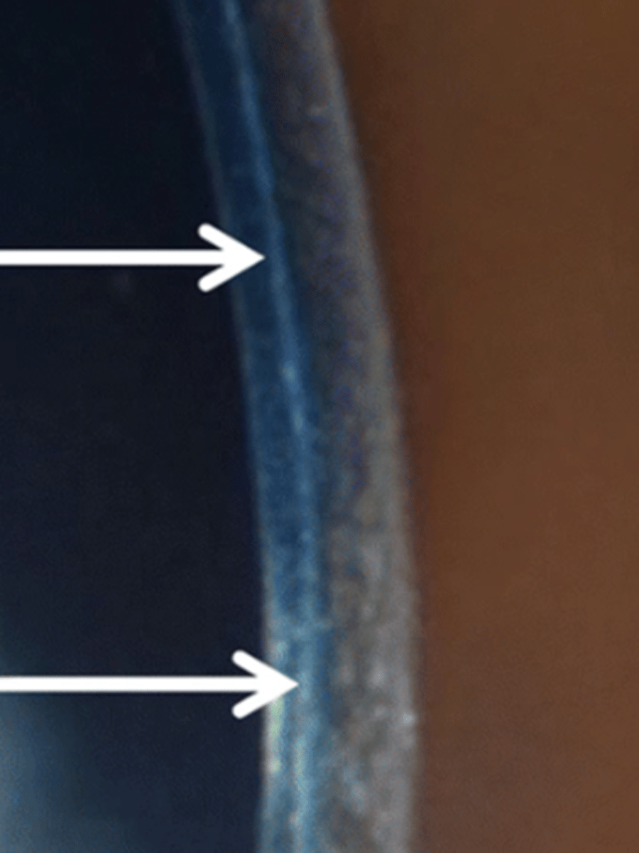 <p>What is the difference between an inlay vs onlay graft in a Bowman's layer transplantation (BLT)?</p>
