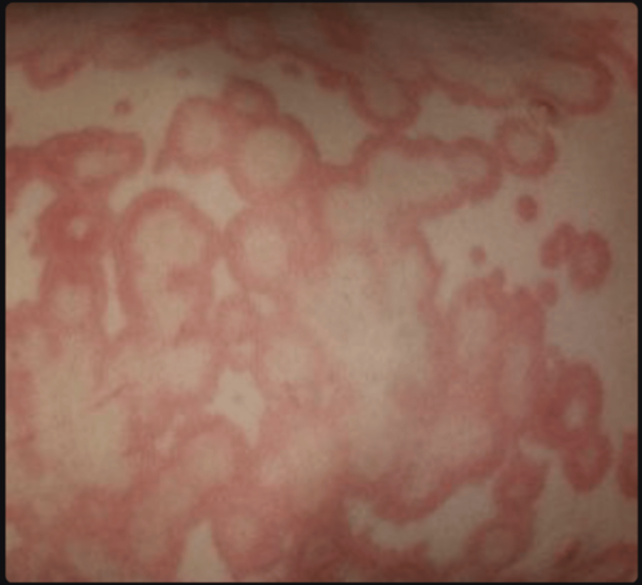<p>- Pruritus (itching), often intense</p><p>- Erythematous wheals with well-defined borders (sometimes with a central clearing - as seen in picture)</p><p>- Wheals that vary in size and shape</p><p>- Rapid onset and resolution (usually within 24 hours)</p><p>- Occasionally, angioedema (swelling of deeper tissues), which can involve the lips, eyelids, or extremities</p>