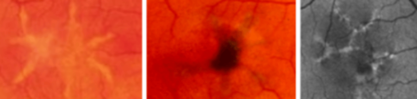 <p>an autosomal dominant disease presenting in the 2nd-6th decade as bilateral star shaped yellow lesions of the macula. Prognosis is good, CNVM and atrophic maculopathy rarely occurs. ERG may be slightly subnormal. EOG often depressed.</p>