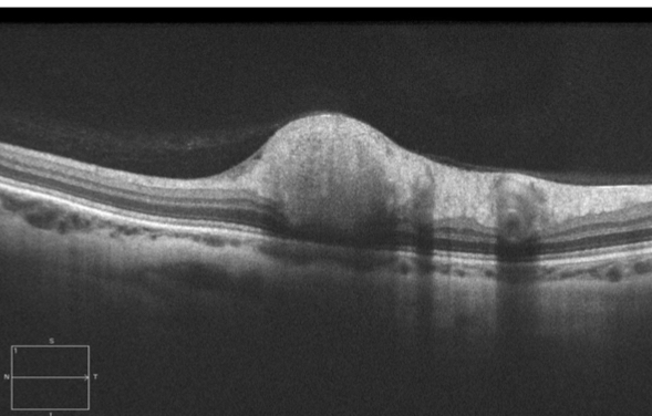 <p>superficial hyper-reflective nodule at RNFL</p><ul><li><p>posterior shadowing</p></li><li><p>inner retinal thinning (“depression sign”) may be noted following resolution of CWS</p></li></ul><p></p>