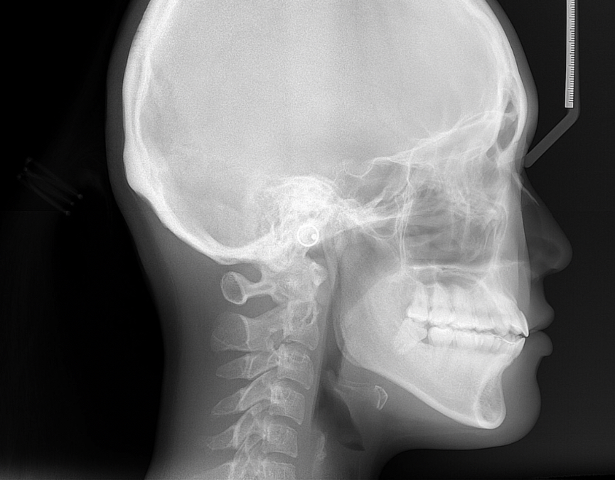 <p>cephalometric radiographs</p>