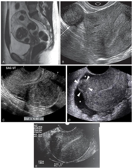 <p> <strong><em>Also called Myomas, Fibroids, and Fibromyomas</em></strong></p><p class="p1"> <strong><em>Most common pelvic tumor</em></strong></p><p class="p1"> <strong><em>More common in African American women nulliparous (never borne offspring)</em></strong></p><p class="p1"> Smooth muscle cell composition</p><p class="p1"> Liquefaction, necrosis, hemorrhage, and ultimate calcification may take place.</p><p class="p1"> Degeneration occurs when myomas outgrow their blood supply; calcification</p><p class="p1"> May be pedunculated</p><p class="p1"> Clinical symptoms include</p><p class="p2">➢ enlarged uterus</p><p class="p3">➢ profuse and prolonged bleeding</p><p class="p3">➢ pain</p><p class="p3"> Myomas are <strong><em>estrogen dependent </em></strong>and may increase in size during pregnancy, although about half of all</p><p class="p1">myomas show little change during pregnancy.</p><p class="p1"> Myomas identified in the first trimester are <strong><em>associated with an elevated risk of pregnancy loss</em></strong>, and</p><p class="p1">this risk is higher in patients with multiple myomas.</p><p class="p1"> They <strong><em>rarely develop in postmenopausal women</em></strong>, and most stabilize or decrease in size following</p><p class="p1">menopause because of a lack of estrogen stimulation.</p><p class="p1"> They <strong><em>may increase in size in postmenopausal patients who are undergoing hormone replacement</em></strong></p><p class="p1"><strong><em>therapy.</em></strong></p><p class="p1"> <strong>Tamoxifen</strong> has also been reported to cause growth in leiomyomas. A rapid increase in myoma size,</p><p class="p1">especially in a postmenopausal patient, should raise the level of concern for a neoplasm.</p><p class="p1">The signs and symptoms of leiomyomas depend on their size and location.</p><p class="p1"><strong><em> Submucosal myomas </em></strong>may erode into the endometrial cavity and <strong><em>cause irregular</em></strong></p><p class="p1"><strong><em>or heavy bleeding</em></strong>, which may lead to anemia.</p><p class="p1"> <strong><em>Fertility</em> </strong>may be affected by <strong><em>submucosal or intramural myomas</em></strong>, which may</p><p class="p1">impede sperm flow, prevent adequate implantation, or cause recurrent miscarriages.</p><p class="p1"> It is particularly important to diagnose <strong><em>submucosal leiomyomas </em></strong>because they are a</p><p class="p1">well-established cause of <strong><em>dysfunctional uterine bleeding, infertility, and</em></strong></p><p class="p1"><strong><em>spontaneous abortion</em></strong>. Small submucosal leiomyomas may be removed</p><p class="p1"><strong>hysteroscopically (</strong>a fibroid removal treatment<strong>)</strong>.</p><p class="p1"> Uncommonly, a <strong>pedunculated subserosal </strong>lesion develops a <strong><em>long stalk and is</em></strong></p><p class="p1"><strong><em>migratory</em></strong>; it can implant into the blood supply of the broad ligament, omentum, or</p><p class="p1">the bowel mesentery.</p><p class="p1"> <strong><em>Transvaginal sonography is often helpful in showing the uterine origin of the</em></strong></p><p class="p1"><strong><em>mass and identifying the stalk. </em></strong>Occasionally, a pedunculated myoma becomes</p><p class="p1">adherent to surrounding structures and develops an auxiliary blood supply.</p><p class="p1">Sonographic Findings of Leiomyomas</p><p class="p2">• Uterine enlargement or irregular uterine wall contour with a heterogeneous myometrial texture pattern.</p><p class="p2">• Look for contour distortion along the interface between the uterus and bladder.</p><p class="p2">• The myomas alters the normal homogeneous myometrium</p><p class="p2">• Myomas can be associated with endometrial infection and cancer.</p><p class="p2">• Blood debris and polyps can artifactually widen the endometrium; therefore definitive diagnosis of the</p><p class="p2">cause of abnormal bleeding require an <strong><em>endometrial biopsy</em></strong>.</p><p class="p2">• Cystic <strong><em>degeneration can occur</em></strong> during pregnancy <strong><em>and cause pain</em></strong>. Doppler should be used to assess</p><p class="p2">the vascularity of myomas.</p><p class="p2"> The sonographic study should include <strong>measurement of the uterus in three dimensions</strong>: (1) cervix to</p><p class="p1">fundus, (2) widest anteroposterior diameter, and (3) widest transverse diameter at fundus diameter.</p><p class="p1"> The <strong>texture of the myoma </strong>(calcific, complex, or anechoic), <strong>size</strong>, and <strong>location are described</strong>.</p><p class="p1"><strong>Individual myomas are measured if they are discrete</strong>.</p><p class="p1"> The <strong>shape of the endometrial complex and its thickness are also described</strong>; alterations in the</p><p class="p1">endometrial border will be evident if a myoma is present. This is especially important in women with a</p><p class="p1">history of abnormal bleeding.</p><p class="p1"> Myomas can be associated with endometrial infection or cancer. Blood debris and polyps can</p><p class="p1">artifactually widen the endometrium; therefore, definitive diagnosis of the cause of abnormal bleeding</p><p class="p1">might require an endometrial biopsy or sonohysterography.</p><p class="p1"> Although ultrasound is used to identify myomas in women with abnormal bleeding, uterine</p><p class="p1">enlargement, or infertility, <strong><em>MRI—with its tissue differentiation characteristics—can be more</em></strong></p><p class="p1"><strong><em>sensitive for evaluating the exact location, size, and number of myomas.</em></strong></p><p class="p2"></p>