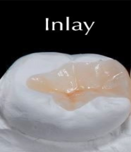 <p>A custom filling that fits inside the grooves of a tooth but does not cover the cusps.</p>