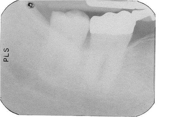 <p><span>What receptor exposure error caused the image to appear as above?</span></p>